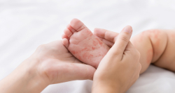 Alergi Makanan Pada Si Kecil yang Masih Bayi dan Cara Penanganannya